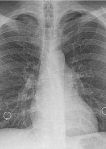 Патологоанатом рассказал о состоянии лёгких больных коронавирусом: «Это не пневмония»